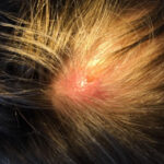 Photo of the patient’s scalp prior to surgery. The larva’s breathing hole is visible.