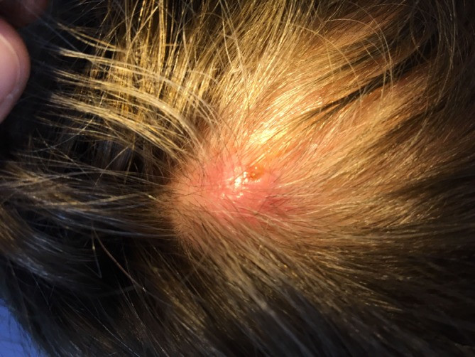 Photo of the patient’s scalp prior to surgery. The larva’s breathing hole is visible.