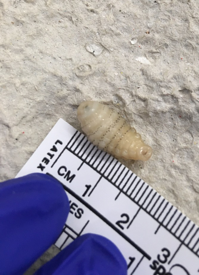 The first botfly larva, extracted on the ward after application of Vaseline, measuring 1.5×0.5 cm.
