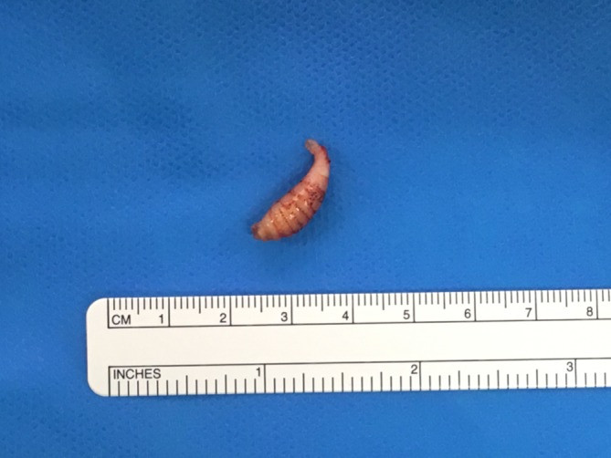 The second botfly larva, removed following surgical excision, with breathing tube intact.