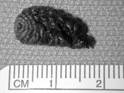 Bot fly larvae burrow into the skin
