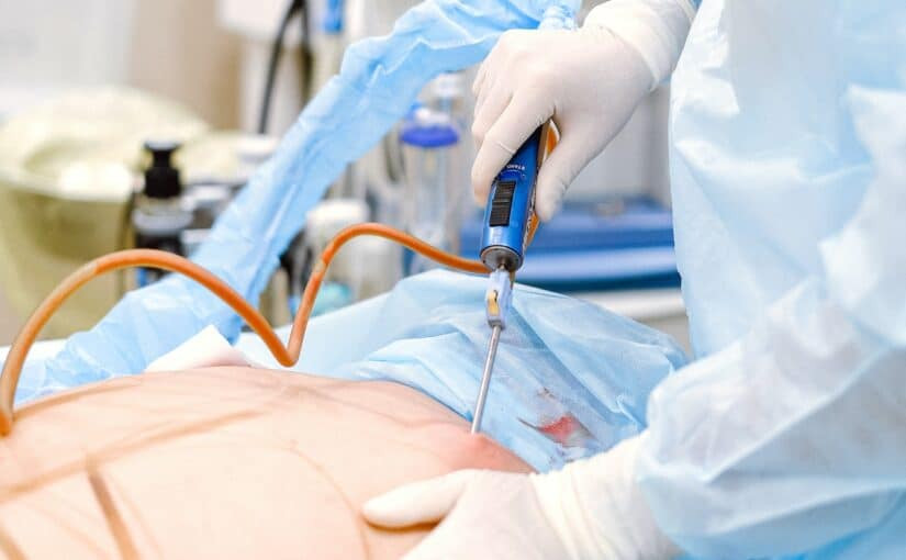 Woman smiling after liposuction, highlighting the self-esteem boost